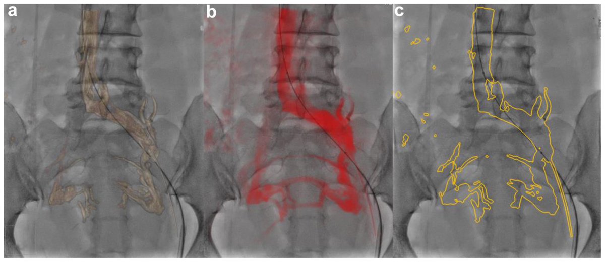 JVSVL's tweet photo. It’s #VenousPhotoFriday! 🎉 Check out this newly published paper on using 3D venography &amp; fusion imaging for iliac vein stenting in patients with May Thurner syndrome. Let us know what you think! 

https://t.co/M2wAezP19J

#VenousEd #VascSurg https://t.co/dkoTQFWQNw