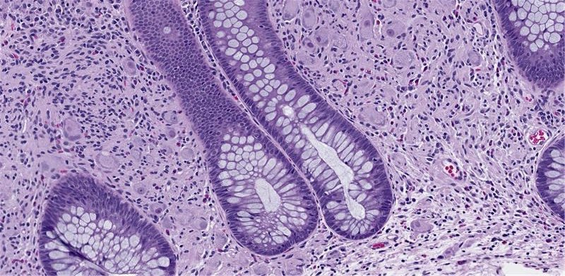 drtimbracey's tweet image. 1cm polyp at anastamotic site of previous colectomy. What’s the diagnosis and the potential associated syndrome? #pathtwitter #GIPathology