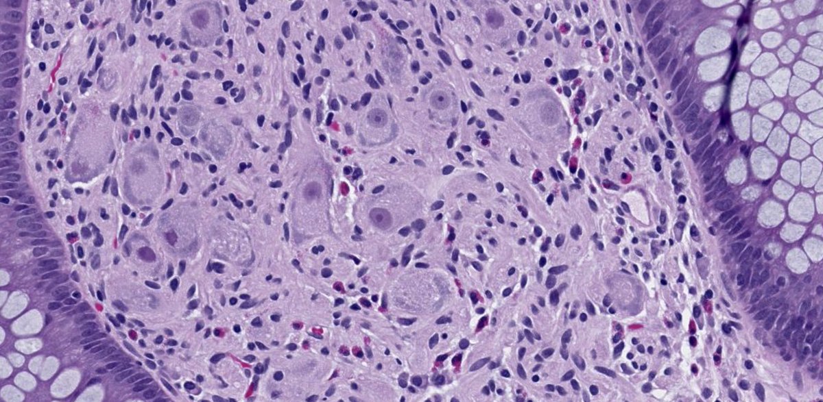 drtimbracey's tweet image. 1cm polyp at anastamotic site of previous colectomy. What’s the diagnosis and the potential associated syndrome? #pathtwitter #GIPathology