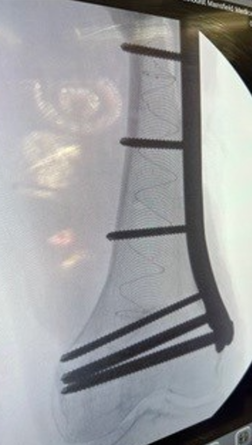 IlluminOss Medical tweet media