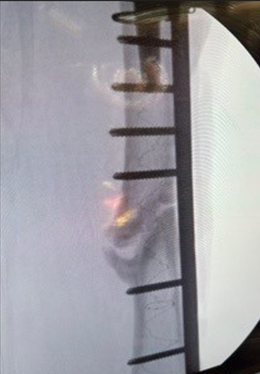 IlluminOss Medical tweet media