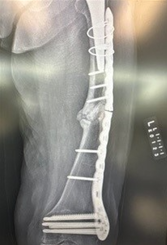 IlluminOss Medical tweet media