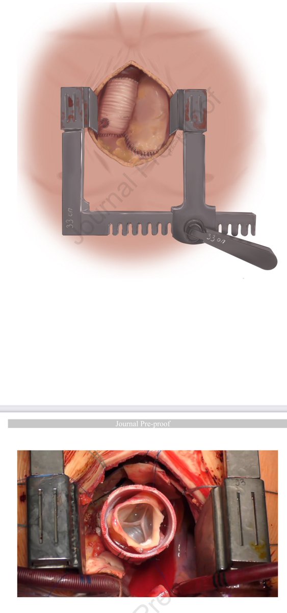 At a recent Aortic Symposium 2024 we presented our current approach to Ross procedure. The article describing the technique is already available as a journal pre-proof

sciencedirect.com/science/articl…

#rossprocedure #avr