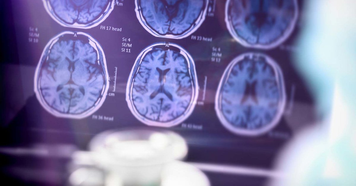 alwaysbestns's tweet photo. 🧠💜 June is Alzheimer's and Brain Awareness Month! 

Every 3 seconds, someone develops dementia. Let's raise awareness and support those affected. 

🔗 [Alzheimer's Association](https://t.co/8X84CzItB1)

#EndAlz #BrainHealth #AlzheimersAwareness #BrainHealth #MemoryMatters https://t.co/6BwAkoSUOH