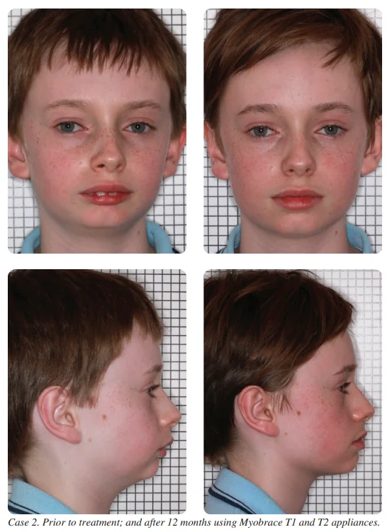 JohnFlutter's tweet image. After 1 year on the Myobrace system, his facial improvement could be mistaken for surgery.
Unlike conventional orthodontics, which mechanically forces the teeth into alignment,
The Myobrace system resolves the underlying cause of crooked teeth and guides the growth of the jaws.
