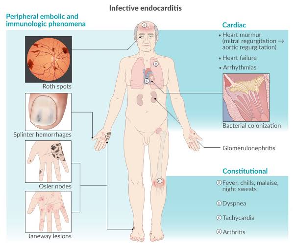 ZHeart11768530's tweet photo. 🔴Clinical manifestations of Infective Endocarditis

#Diagnosis #Signs #Symptoms #Infective #Endocarditis #Manifestations #Janeway #Roth #OslerNodes #Splinter #PhysicalExam
#CardioTwitter #Cardiology #surgery #anesthesiology #MedEd  #CriticalCare #FOAMcc #FOAMed  #surgery https://t.co/qQDvnJ58Uv