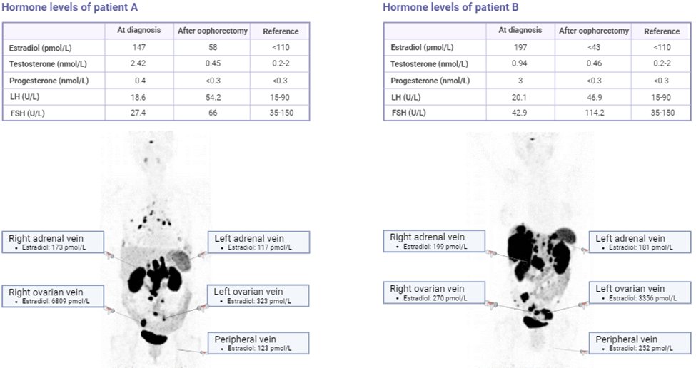 We discovered a new 🦓 syndrome: bleeding-associated hyperestrogenism in postmenopausal women due to ovarian neuroendocrine tumor metastases. Out now in <a href="/EJEndo/">Euro J Endocrinology</a>: academic.oup.com/ejendo/article…