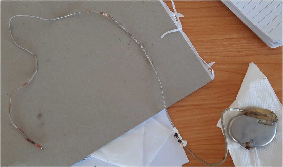 The self-extracted pacemaker system heartrhythmcasereports.com/article/S2214-…