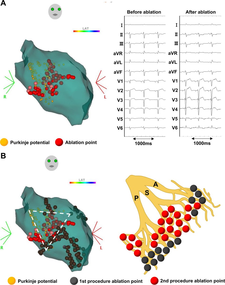 HRS_CaseReports's tweet photo. Significance of extensive ablation targeting Purkinje-muscle junction of all the left fascicles for suppressing Purkinje-related ventricular arrhythmias: A case report https://t.co/1o0byeXlCS https://t.co/BifcvSKdt6
