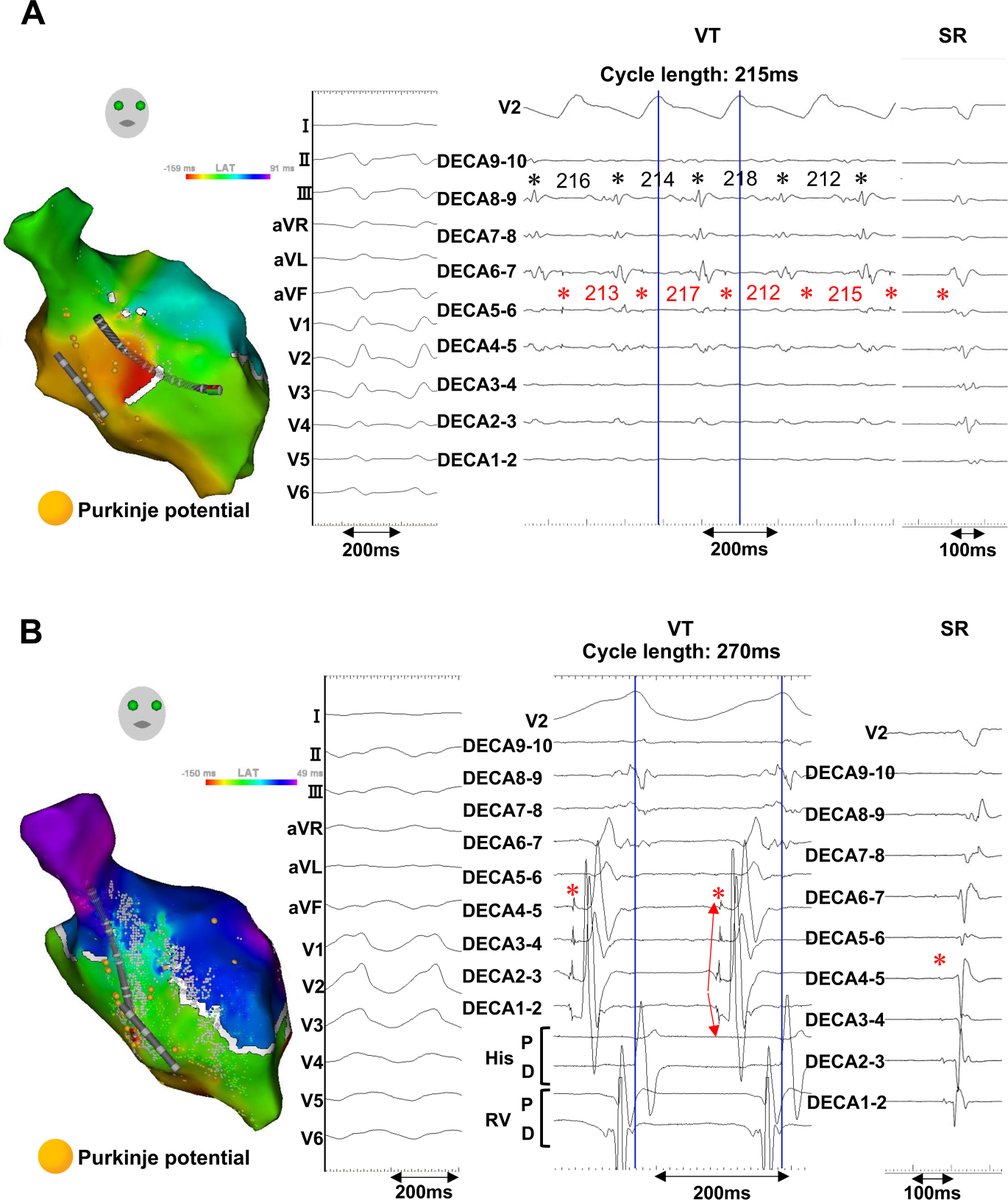 HRS_CaseReports's tweet photo. Significance of extensive ablation targeting Purkinje-muscle junction of all the left fascicles for suppressing Purkinje-related ventricular arrhythmias: A case report https://t.co/1o0byeXlCS https://t.co/BifcvSKdt6