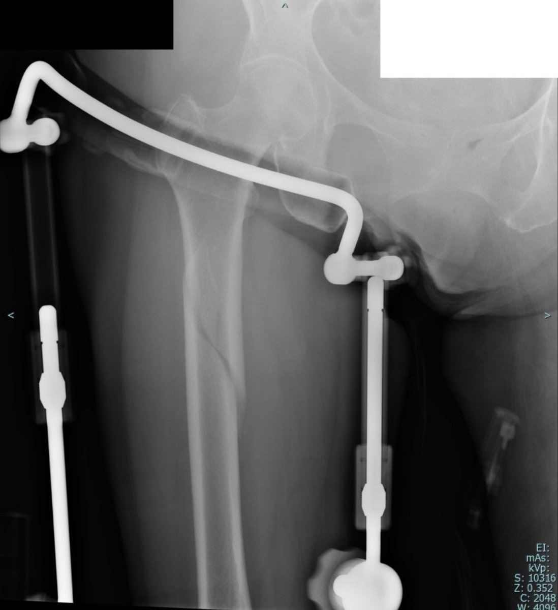 orthotraumamd's tweet photo. Great to see the comments from around the world on this recent case published at @orthobullets with Chirag Soni
https://t.co/10CoXLrQPh
What's your post-op algorithm for osteoporotic/fragility fractures? #Orthobullets #FractureManagement https://t.co/flXNO2TQDB
