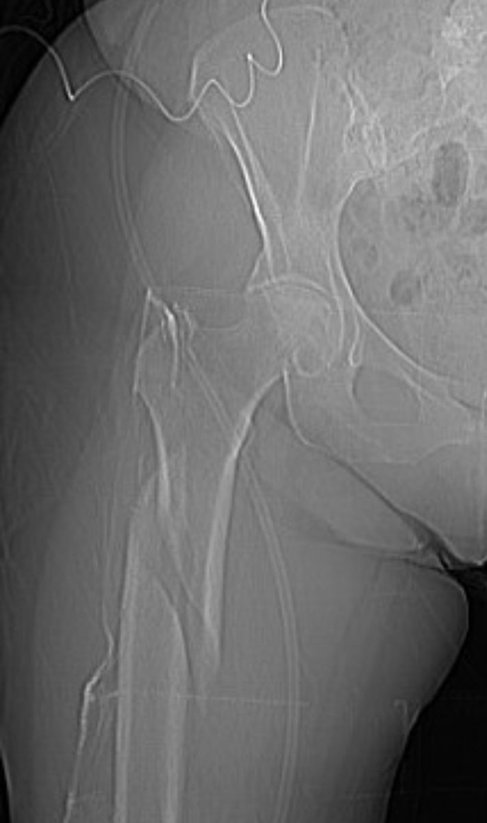 orthotraumamd's tweet photo. Great to see the comments from around the world on this recent case published at @orthobullets with Chirag Soni
https://t.co/10CoXLrQPh
What's your post-op algorithm for osteoporotic/fragility fractures? #Orthobullets #FractureManagement https://t.co/flXNO2TQDB