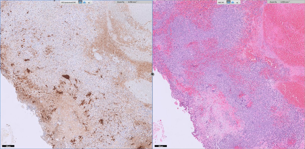 slusagar's tweet photo. #GUpath TURBT:
urothelial carcinoma with trophoblastic differentiation

(paired #IHCpath is HCG) https://t.co/7usAmuBjJ7
