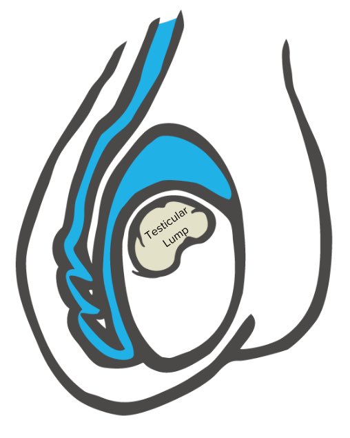 Signs and symptoms of testicular cancer - …sticularcancerawarenessfoundation.org/signs-and-symp…

#testicularcancer #urology 
#menshealth