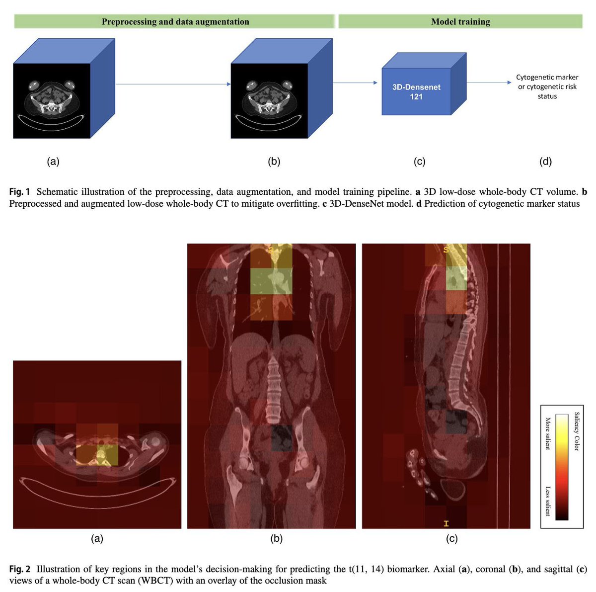 ShahriarFaghani's tweet image. Prediction of cytogenetic risk in multiple myeloma without a bone marrow biopsy! 🤯Thanks to @ManaMSF94 ,Mayo Hem-once colleagues and my mentors @frbaffour @Slowvak 
#multiple_myeloma #deep_learning #radiogenomics rdcu.be/dL8tG