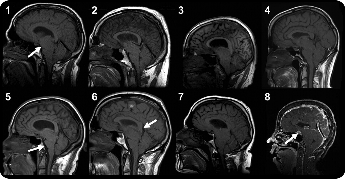 dr_kevinlee's tweet photo. Frontotemporal brain sagging syndrome #FBSS that mimics frontotemporal dementia - hypometabolism on PET/SPECT, MRI can show brainstem swelling https://t.co/jufY9kkKXs https://t.co/yZhDcCaEup