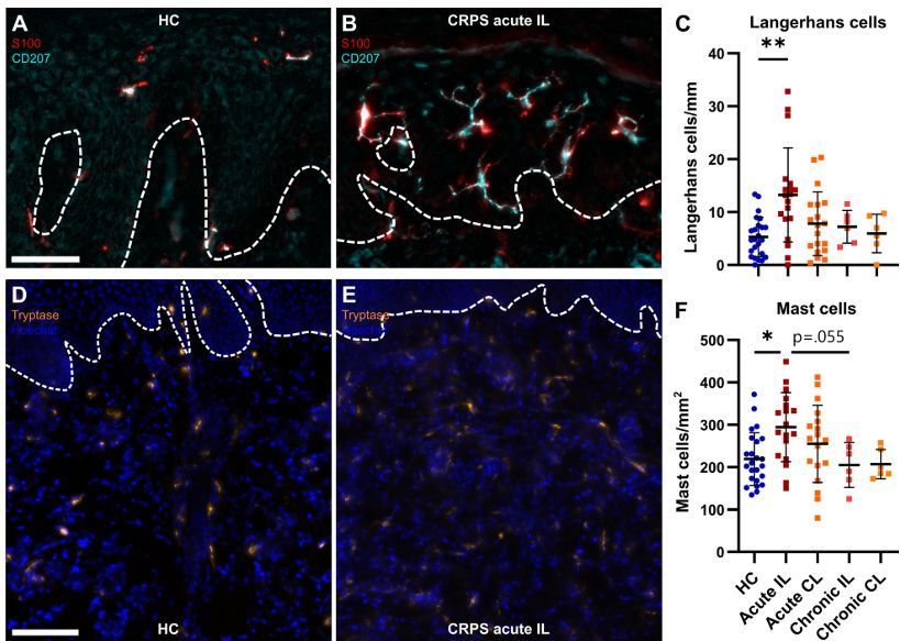 🔬 Immune cells and CRPS reveal a complex relationship. Acute cases exhibit immune activation with increased mast and Langerhans cells, which normalize in chronic instances. This suggests potential for tailored treatments.

🔗buff.ly/4cuR0eM