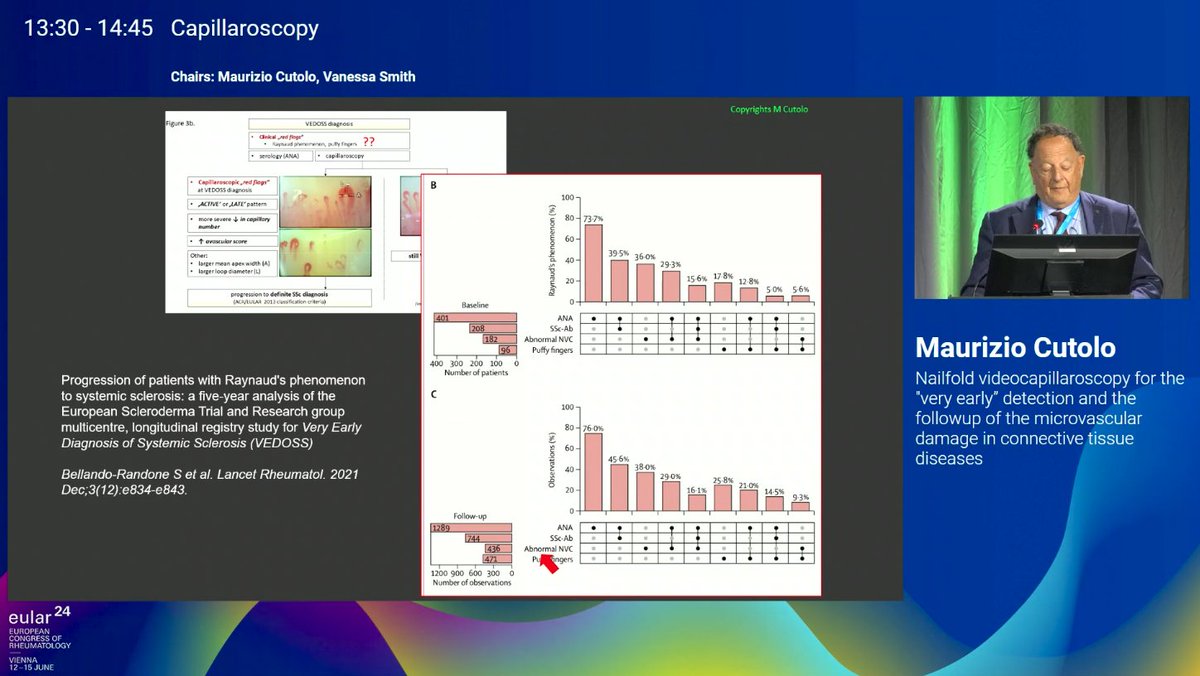 kazuomatsui's tweet image. Very happy to see Prof. Maurizio Cutolo!  
His presentation on intermediate pattern is quite interesting!
&quot;We want delete the late pattern in the future&quot;
Congratulation for 20 years of Capillaroscopy course!
#EULAR2024 #WorldSclerodermaday #Scleroderma
pubmed.ncbi.nlm.nih.gov/38287630/