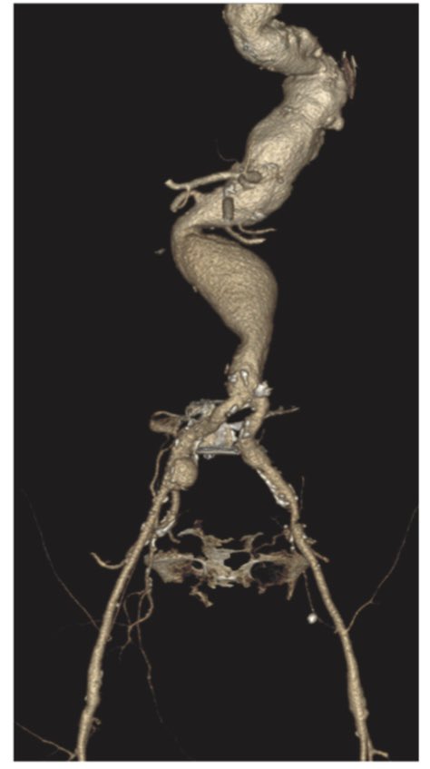 UMiami Vascular Surgery (@umvascular) on Twitter photo Extra-anatomic bypasses as perfusion alternatives in the treatment of complex thoracoabdominal aortic disease
Publication (<a href="/AVSURG/">Annals of Vascular Surgery - Brief Reports</a>): sciencedirect.com/science/articl… Extra-anatomic bypasses as perfusion alternatives in the treatment of complex thoracoabdominal aortic disease
Publication (<a href="/AVSURG/">Annals of Vascular Surgery - Brief Reports</a>): sciencedirect.com/science/articl…
