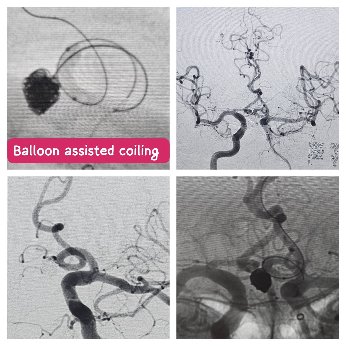SharathKumarGG7's tweet image. Typical case of Balloon assisted coiling for an unruptured Acom artery aneurysm in an elderly gentleman @ApolloKarnataka @SavithKumarINR  #BrainAneurysm #Endovascular #Coiling #Balloon #Neurointervention #Aneurysm #Neurosurgery #Neurology #Neuroradiology #Brain #AneurysmSurvivor