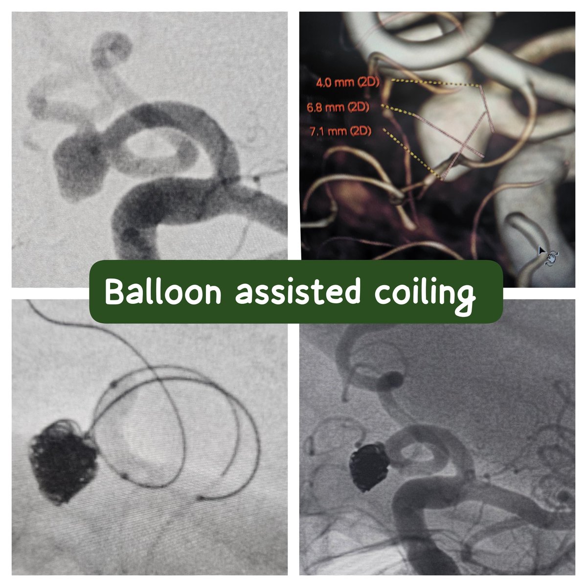 SharathKumarGG7's tweet image. Typical case of Balloon assisted coiling for an unruptured Acom artery aneurysm in an elderly gentleman @ApolloKarnataka @SavithKumarINR  #BrainAneurysm #Endovascular #Coiling #Balloon #Neurointervention #Aneurysm #Neurosurgery #Neurology #Neuroradiology #Brain #AneurysmSurvivor