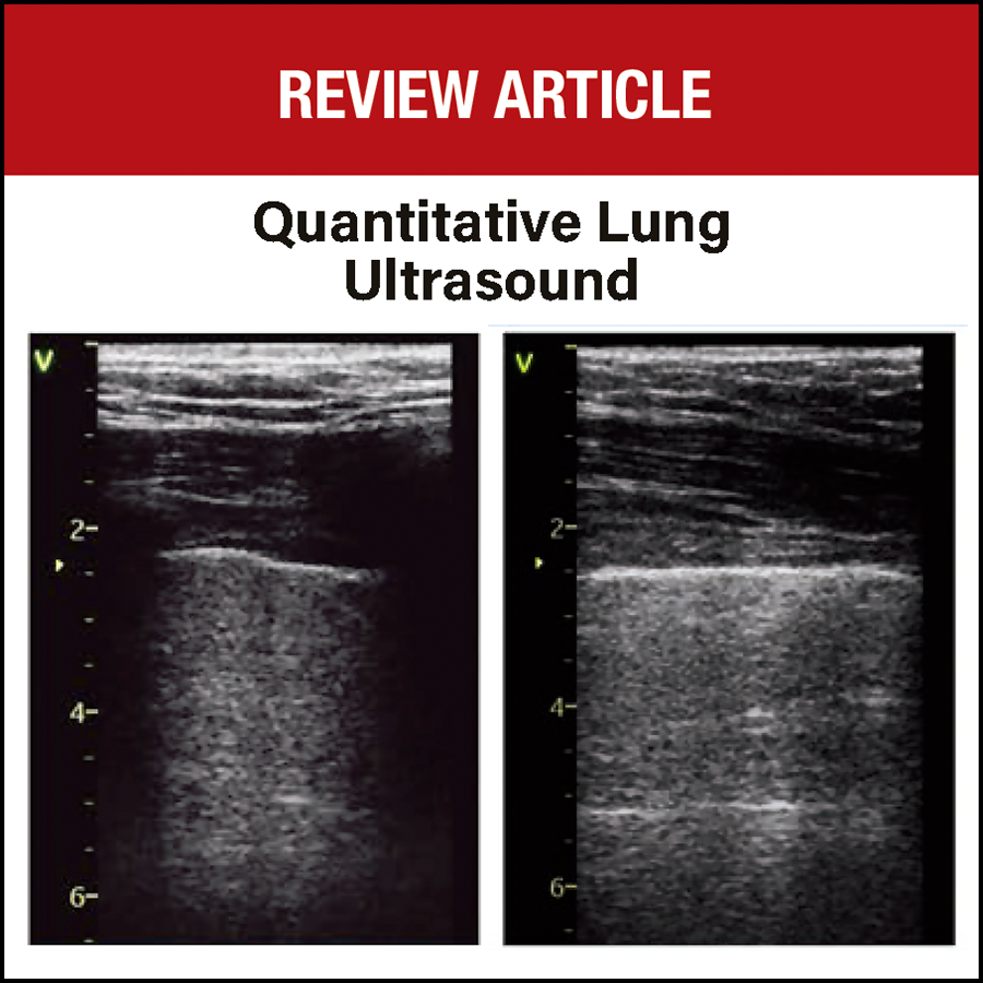 Lung ultrasound permits reliable assessment and monitoring of lung aeration, and multiple scoring systems have been developed in recent years with specific technical aspects. Authors describe how to apply this technique in the appropriate clinical context: ow.ly/F9Hc50Ss8YN