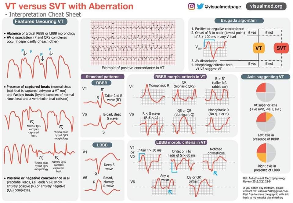 🔴 VT versus SVT with Aberration - Interpretation Cheat Sheet

🔹Features favouring VT
● Absence of typical RBBB or LBBB morphology
● AV dissociation 
● Presence of captured beats 
● Positive or negative concordance in all precordial leads
  #medical #medEd #cardiotwitter