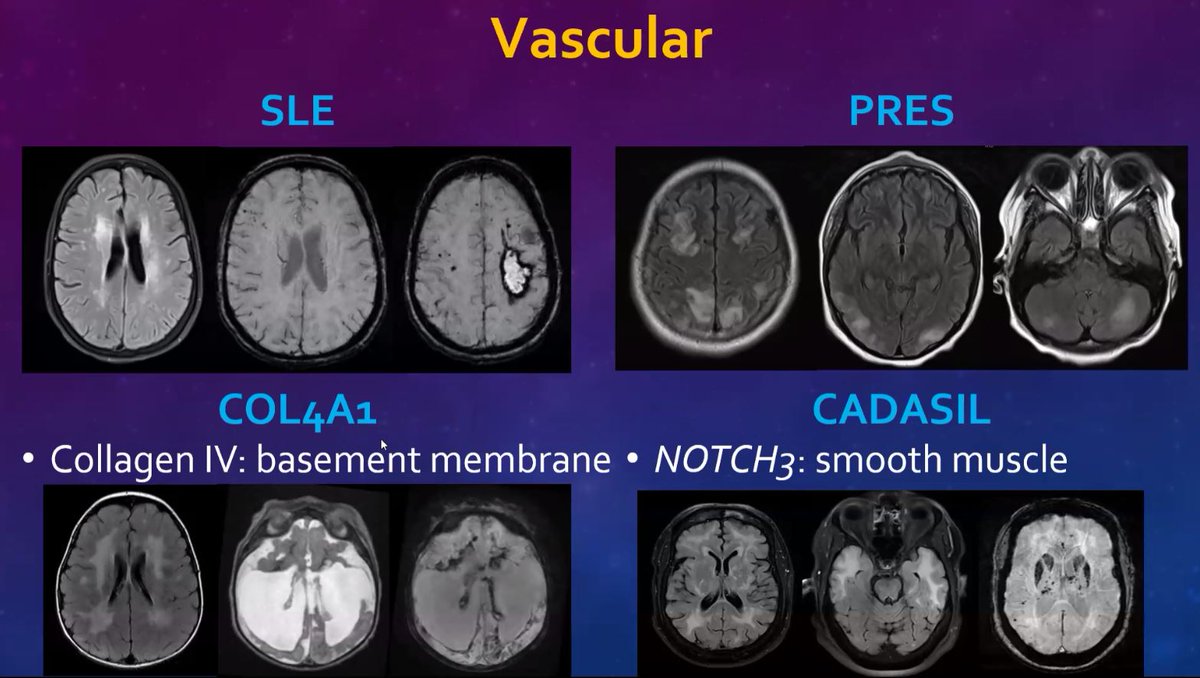 The_ASPNR's tweet photo. Not all diseases of the white matter are leukodystrophies! Remember to consider perinatal, infectious, vascular, autoimmune, toxic, and iatrogenic differentials. @mailanho  #pedineurorad #PedsRad #meded #radres #FOAMrad https://t.co/alGCuIv6ci