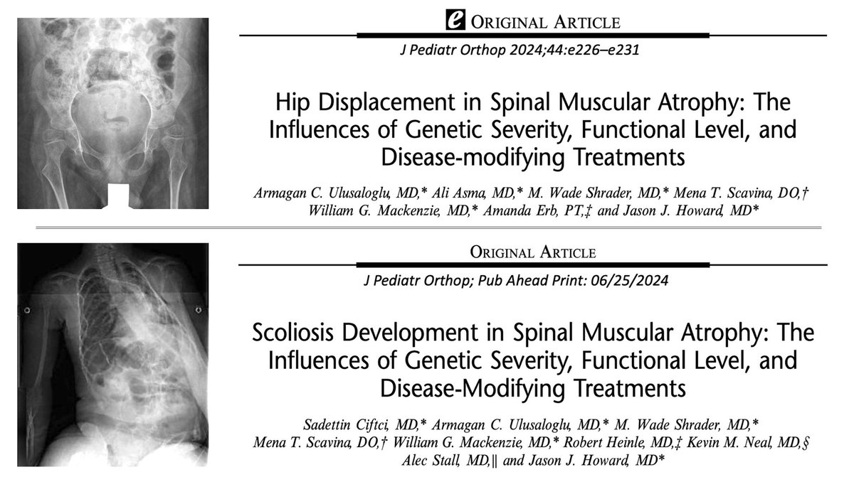 When I started looking after kids with spinal muscular atrophy #SMA almost 20 years ago, the literature was pretty sparse; our knowledge of the prevalence and risk factors of major orthopaedic manifestations such as #scoliosis and #hipdysplasia was limited. In this era before the