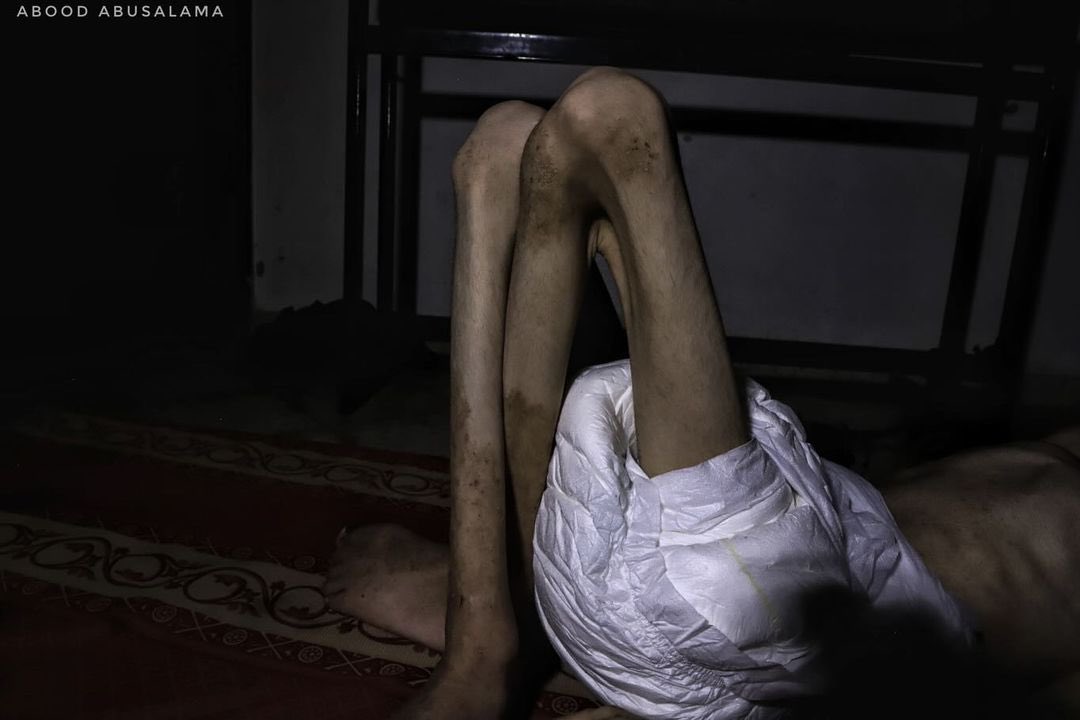 This is how 15-year-old Bahaa Al-Nimr looks now, suffering from severe malnutrition and hepatitis due to the forced famine and ongoing American-Israeli blockade on Gaza City and the Northern Gaza Strip as a whole.