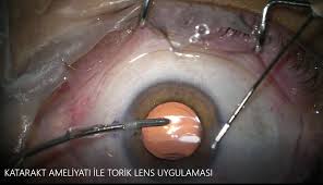 Göze dikiş bile atmadan, 22 mm kesiden katarakt temizleyip, arkadaki 3.5-7 mikron kapsülü koruyup göz numarası 0 layıcı lensi göze takmanın devlette cerraha getirisi 1000 tl. Musluk sıkan adam 2000 alıyor. Laf edince ağladı diyorsunuz, e tamam özelde kendim fiyat seçerim diyoruz