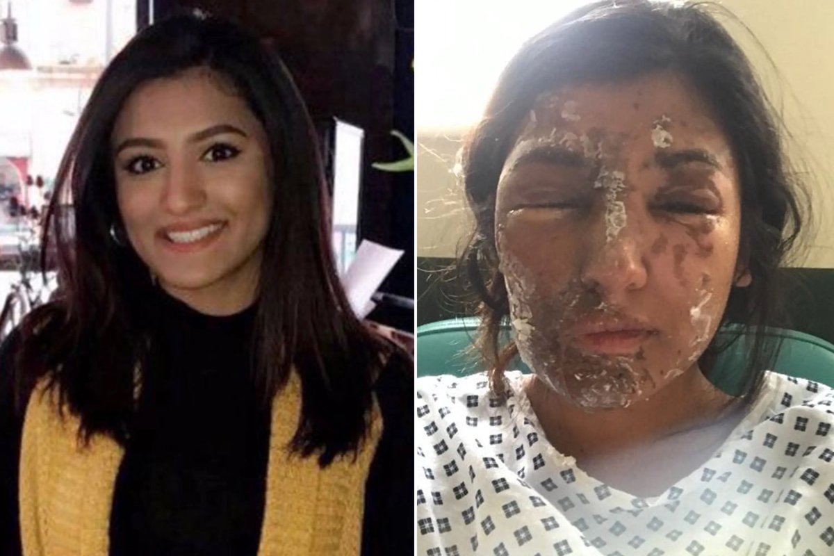 In June 2017, Resham Khan was in a car traveling through East London, preparing to celebrate her 21st birthday. 

Suddenly, a man approached her car as she waited at a traffic light and threw acid on her through the open window. Her cousin, Jameel Mukhtar, also had acid thrown at