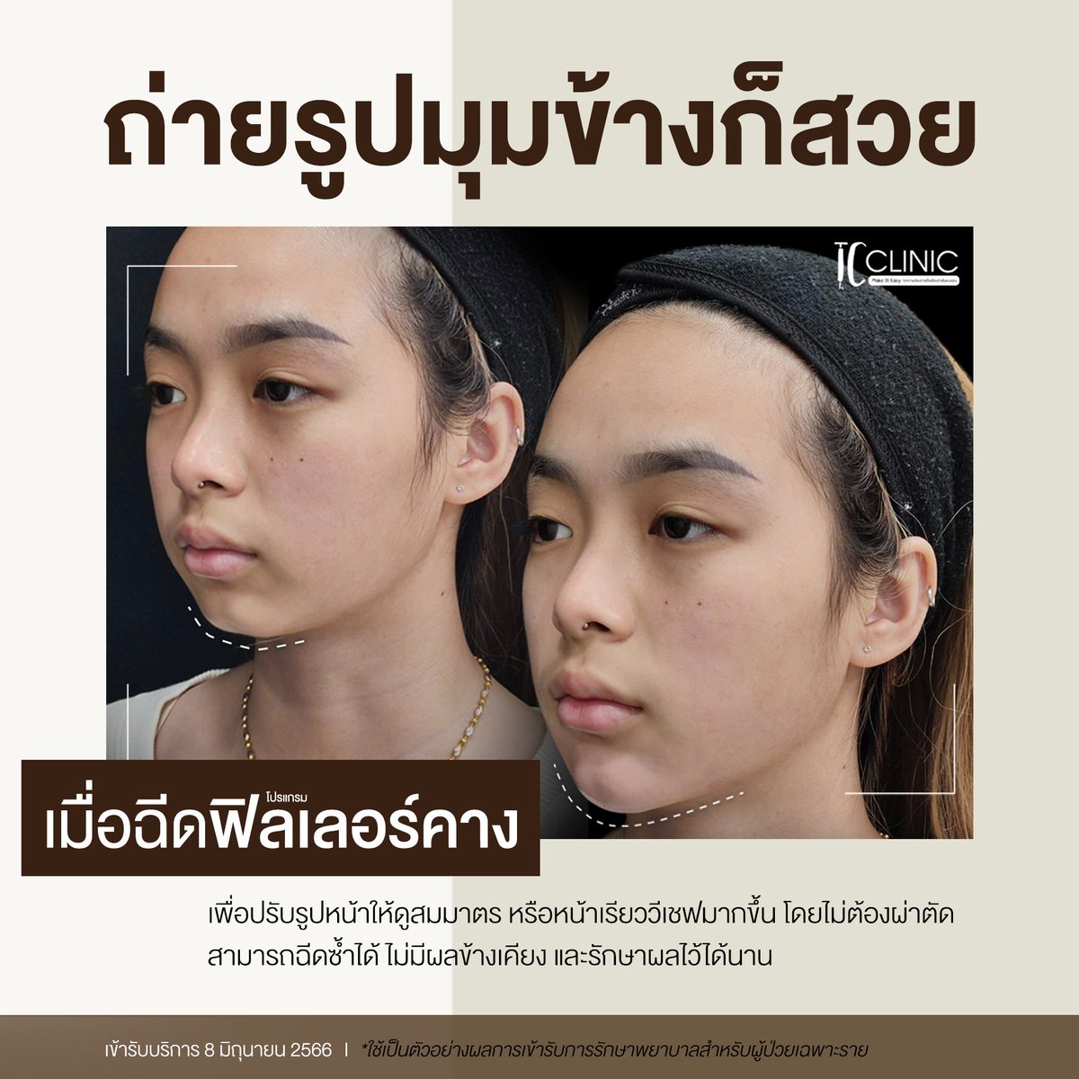 tc_yst's tweet photo. 😱 ว้าวมาก! ถ่ายรูปมุมข้างก็สวย เมื่อฉีดโปรแกรมฟิลเลอร์คาง!!

👉 โปรแกรมฉีดฟิลเลอร์คาง สามารถฉีดซ้ำได้ ไม่มีผลข้างเคียง เ���ื่อปรับรูปหน้าให้ดูสมมาตรและหน้าเรียวมากขึ้น

#ฟิลเลอร์ #filler #ฟิลเลอร์คาง #tcclinic https://t.co/nD3sLDNwTB