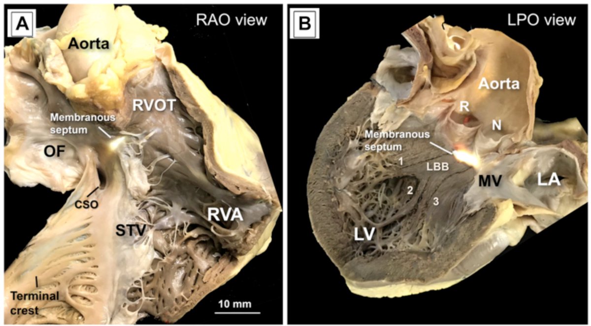 Anatomic reference for LBB pacing