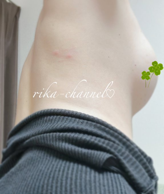 昨夜虫につけられたキスマーク💋  この時期、お外でハッチャケる時ゎ、気をつけてくださいねっ😜💕  何につけられたのか、痛痒いんだよね😅 https://t.co/uqicWkjHbB<a href="/tag/%E3%83%90%E3%83%8B%E3%83%BC"class="tags"><span>#バニー</span></a>