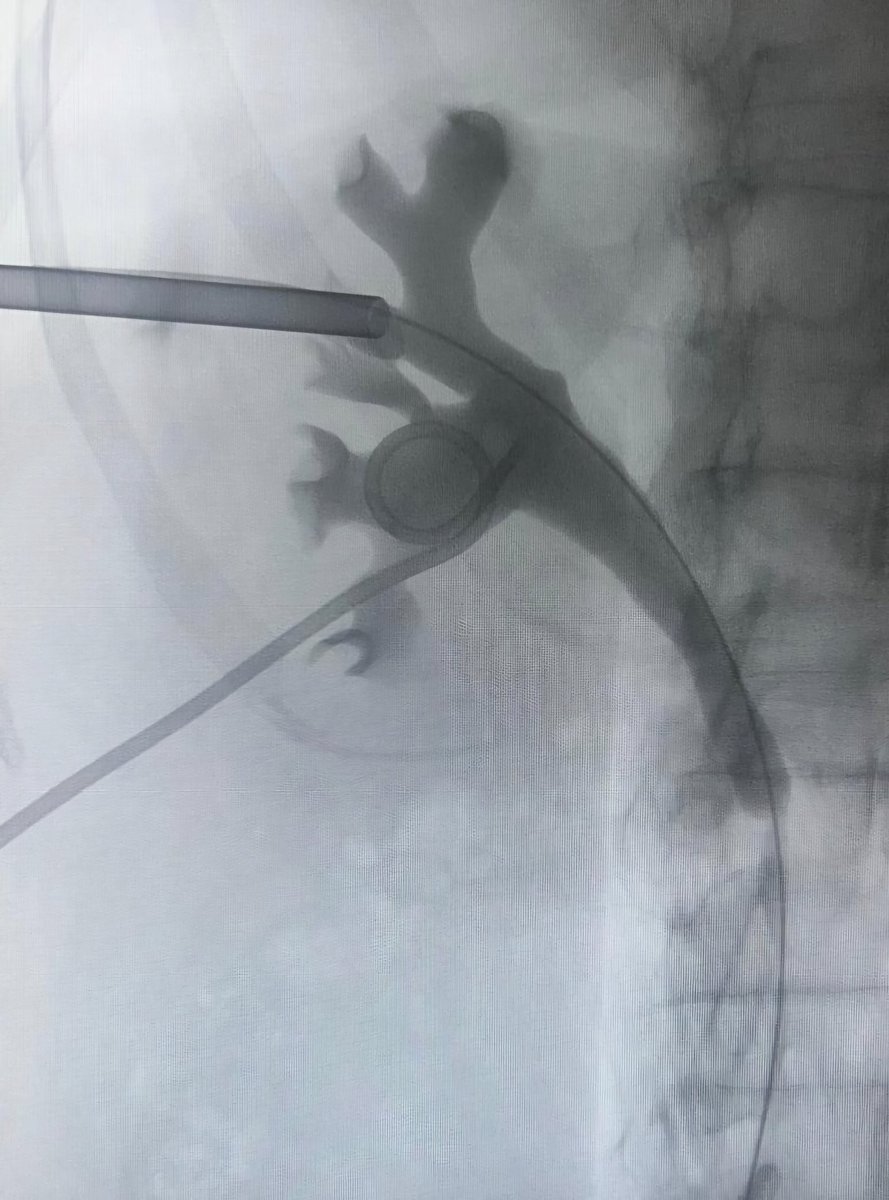 drmarcoscepeda's tweet photo. Workshop on supine #miniperc and #TFL at #HURH
- intercostal approach
- antegrade URS
- miniECIRS
- complex anatomy 

Thanks to Coloplast @EspanaIu for the support 

Congrats to my team! @CoralManso @Guada_ml97 @kikegonzalez11 https://t.co/n2fM20hWRX