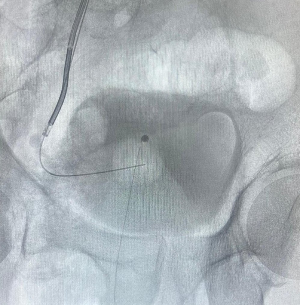 drmarcoscepeda's tweet photo. Workshop on supine #miniperc and #TFL at #HURH
- intercostal approach
- antegrade URS
- miniECIRS
- complex anatomy 

Thanks to Coloplast @EspanaIu for the support 

Congrats to my team! @CoralManso @Guada_ml97 @kikegonzalez11 https://t.co/n2fM20hWRX