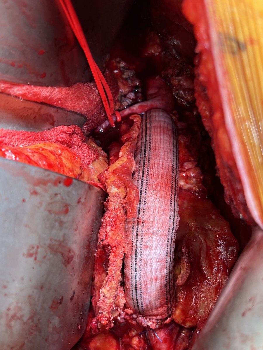 MCW Vascular and Endovascular Surgery (@mcwvascsurg) on Twitter photo Tough to beat the RP approach to the AAA with a lousy neck - gratifying to take the suture bites right through the renal artery orifices. Great job <a href="/mitchelldyermd/">Mitchell Dyer</a>, one of three open AAA by the team the last three days! #aortaed Tough to beat the RP approach to the AAA with a lousy neck - gratifying to take the suture bites right through the renal artery orifices. Great job <a href="/mitchelldyermd/">Mitchell Dyer</a>, one of three open AAA by the team the last three days! #aortaed