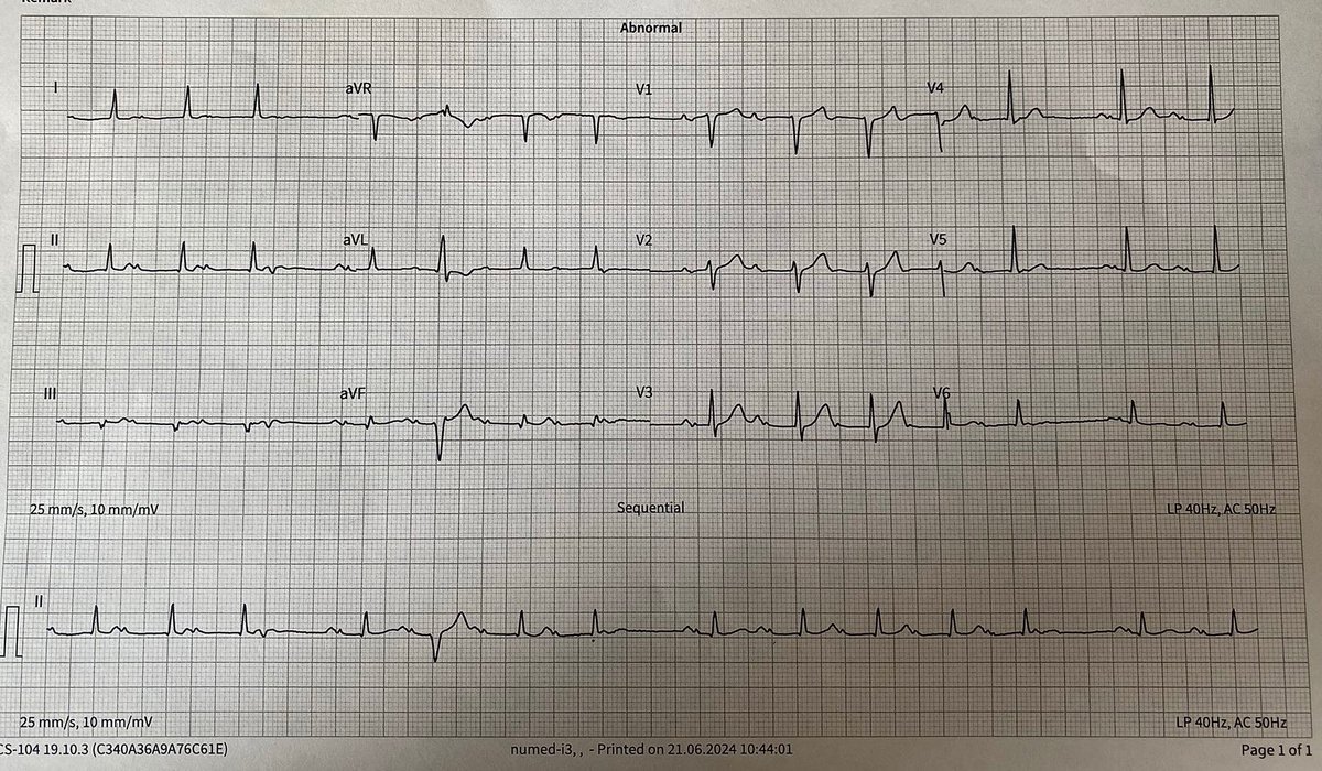 ST4_Cardiology's tweet photo. Congratulations to all those who were successful in their Cardiology interview! 🎉

A 55-year-old man is found to have irregular pulse. What does his 12-lead ECG show? https://t.co/LSumHgsujM
