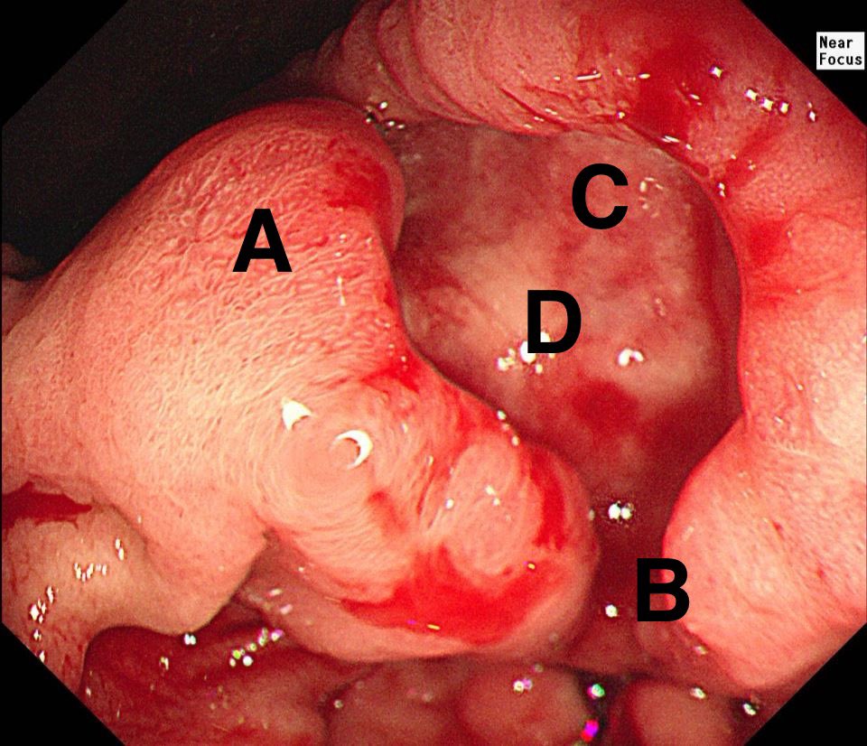 This stomach ulcer turned out to be an adenocarcinoma. Which site should be biopsied for the best diagnostic yield?