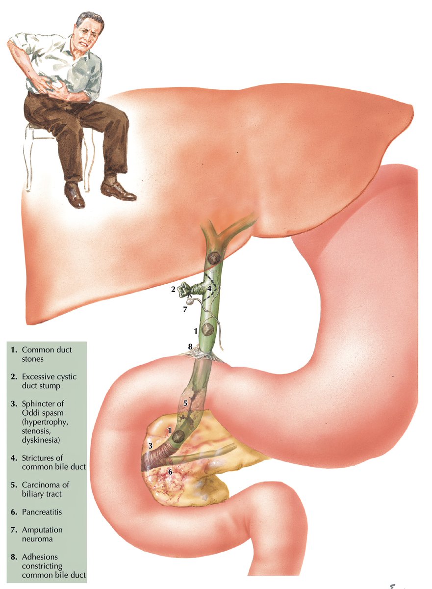 Causes of post-cholecystectomy pain 
📸: Netter’s anatomy