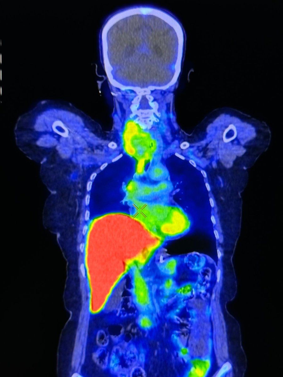 Yash Jain (@the_nuclear_doc) on Twitter photo Perhaps the First PDL1 PET/CT of India
PDL1 PET/CT is a non invasive investigation which gives a novel insight into the PDL1 expression of the whole body tumor burden. Limitation of Biopsy-it gives expression of only that site, which may not be representative of the whole body. Perhaps the First PDL1 PET/CT of India
PDL1 PET/CT is a non invasive investigation which gives a novel insight into the PDL1 expression of the whole body tumor burden. Limitation of Biopsy-it gives expression of only that site, which may not be representative of the whole body.