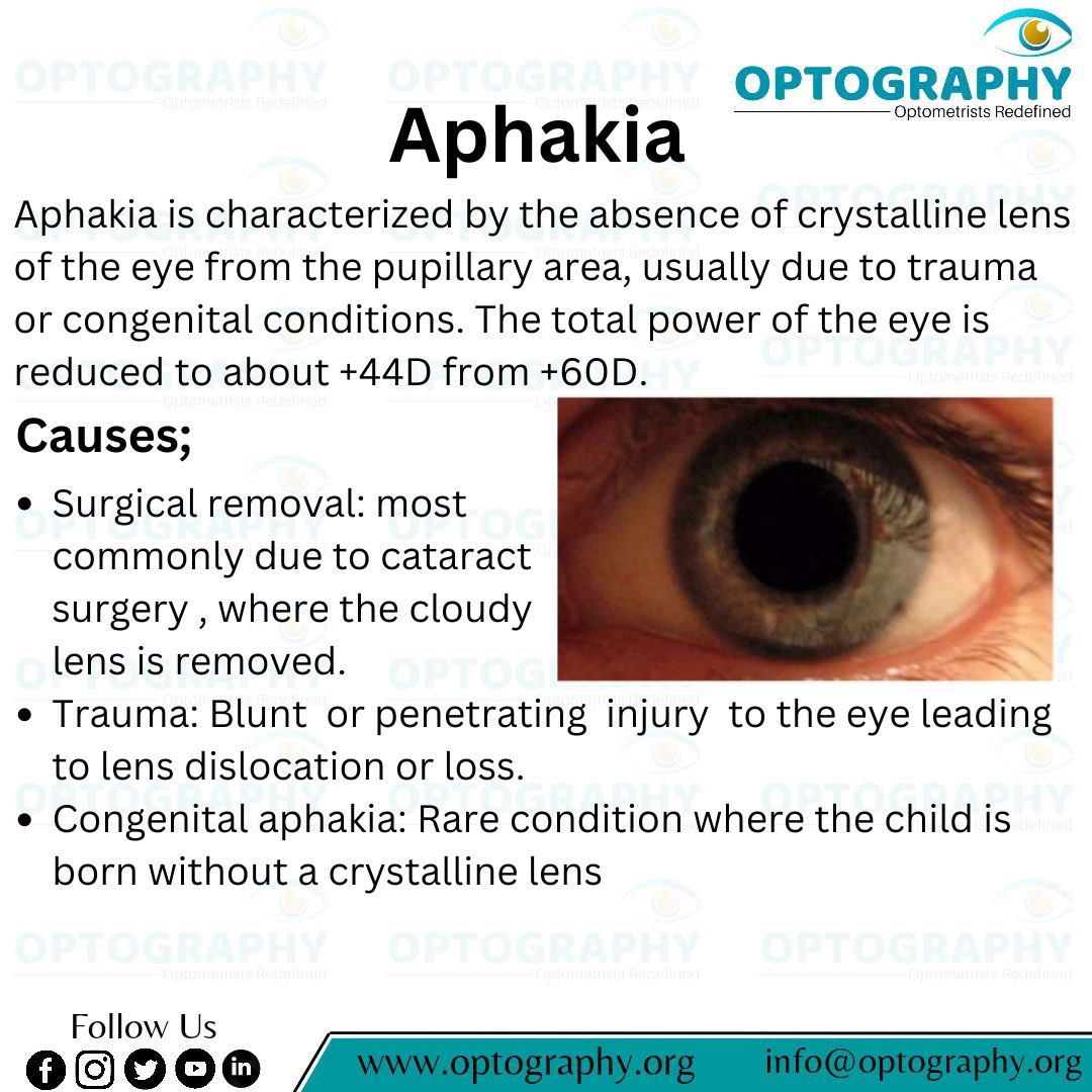 Optography8's tweet photo. #aphakia #optometry #optography #optometrist #thatoptometrist https://t.co/bhrNpDBCMz