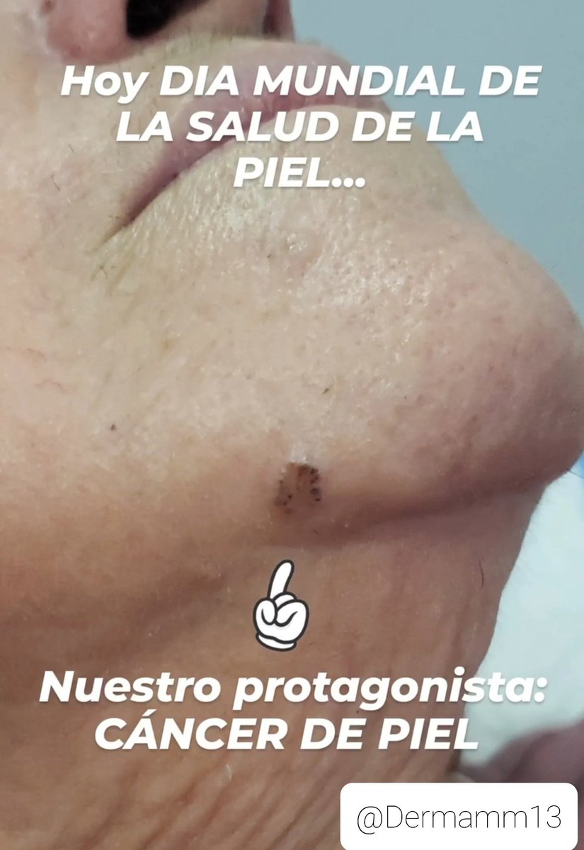 mechemor2014's tweet photo. ⚕ Es importante ACUDIR A EVALUACIÓN CON TU DERMATOLOGO mínimo 1 vez al año. El Diagnóstico Precoz es la Clave. #8julio #skinhealthday #piel #cancerdepiel #Venezuela #zulia @ILDSDerm @svderma https://t.co/6ZBeoc3xA7