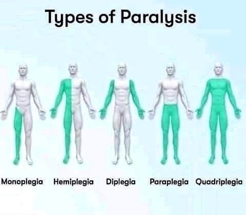 Gazal6849's tweet photo. 🍁Types of paralysis

#medx
#MedTwitter https://t.co/yqnTSBv5lC