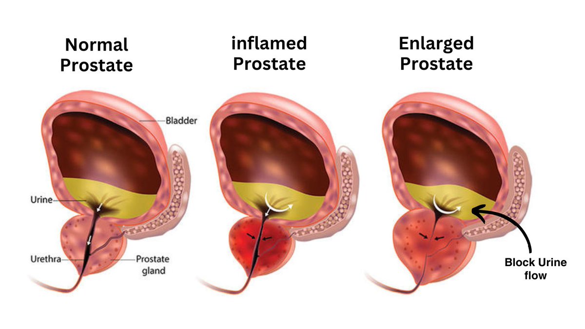𝐄𝐧𝐥𝐚𝐫𝐠𝐞𝐝 𝐩𝐫𝐨𝐬𝐭𝐚𝐭𝐞, or BPH, can cause urinary difficulties in older men. Medications, minimally invasive procedures, and surgery are treatment options. #EnlargedProstate #Urology #urologycliniconline #drnadeembinnusrat #nadeembinnusrat #urologistinpakistan