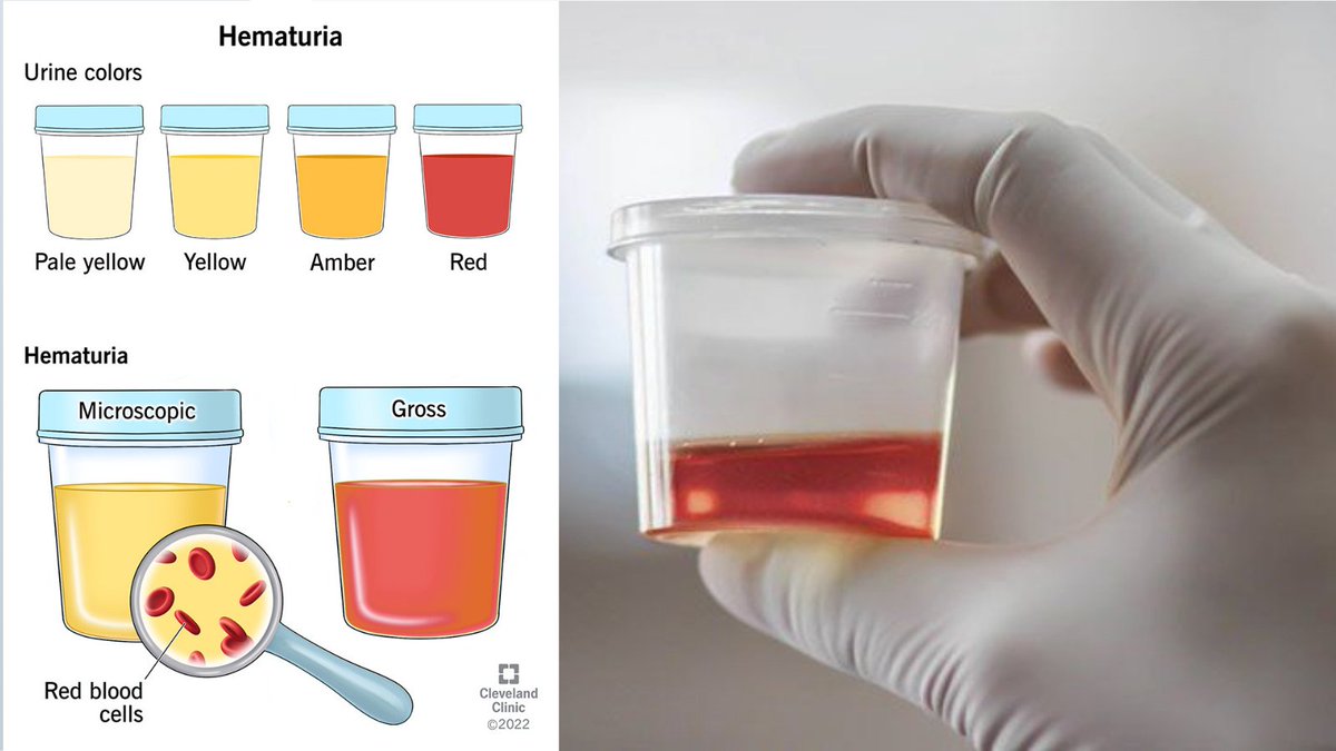 𝐇𝐞𝐦𝐚𝐭𝐮𝐫𝐢𝐚, or blood in urine, can indicate serious underlying conditions. Seek immediate medical attention for proper diagnosis and treatment. #Hematuria #Urology #Health #urologycliniconline #drnadeembinnusrat #nadeembinnusrat #urologistinpakistan #pkliurologist
