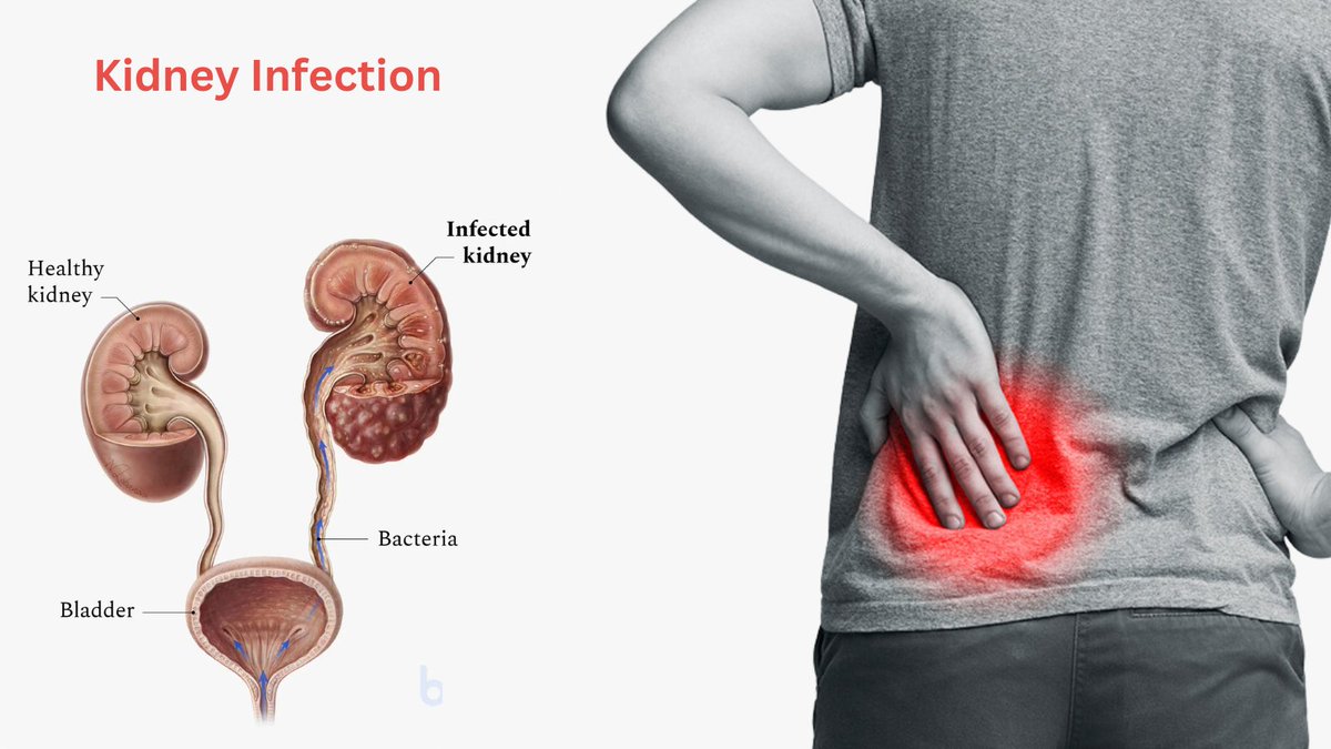 𝐊𝐢𝐝𝐧𝐞𝐲 𝐢𝐧𝐟𝐞𝐜𝐭𝐢𝐨𝐧 symptoms include fever, chills, and back pain. Prompt treatment with antibiotics and plenty of fluids is essential to prevent complications. #KidneyInfection #Urology #urologycliniconline #drnadeembinnusrat #nadeembinnusrat #urologistinpakistan