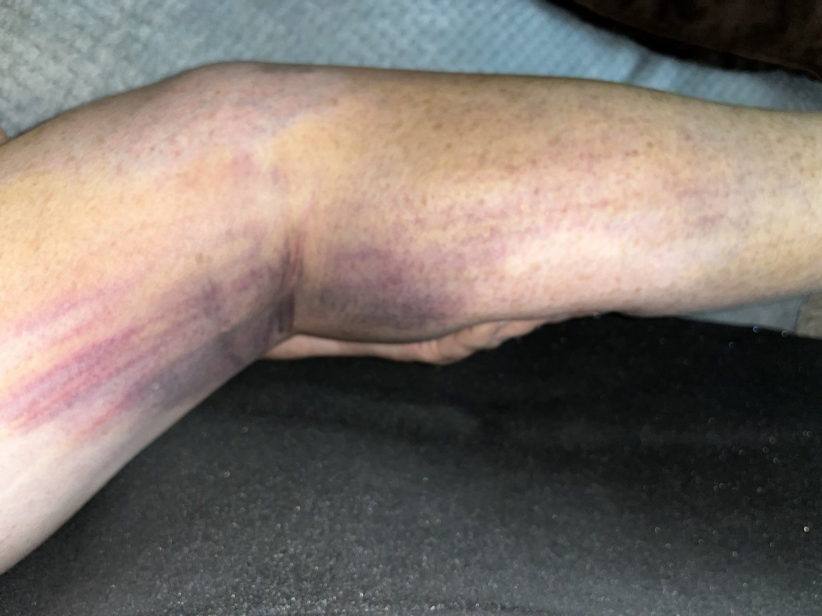 lorasland's tweet photo. So I broke my leg last Wednesday… 😵‍💫 Here are today’s colors.  I have at least two months in a cast and an appointment with a surgeon https://t.co/icHFThFI0G sister has created a Go Fund me to help pay the bills if anyone is so inclined. Thank you 🙏🏻❤️ https://t.co/WhXP9qbaMK https://t.co/AZxKegDcEr