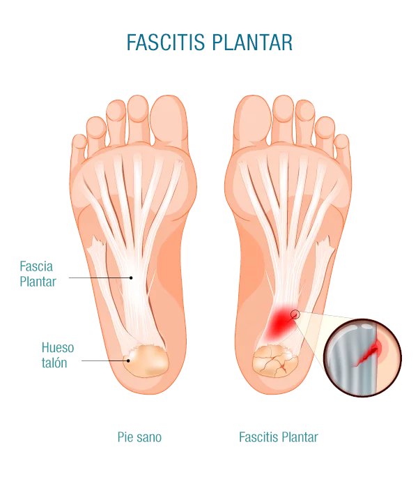 ¿Qué es la Fascitis Plantar?🤔
Abro hilo📌